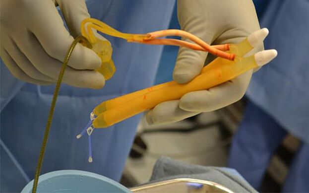Implants on the penis